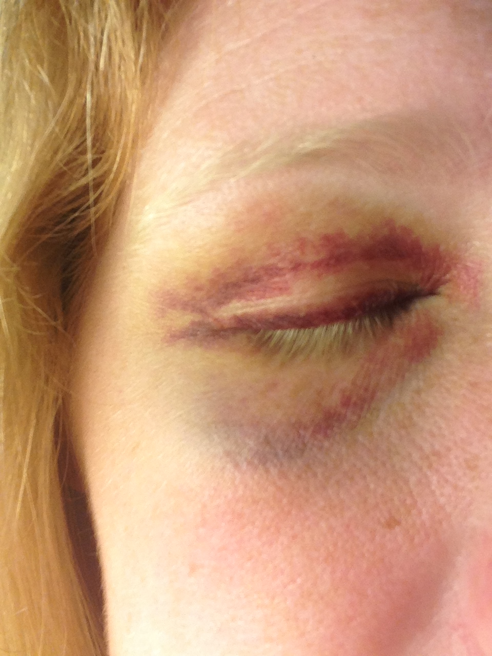 Black eye update. Actually looks worse in person than this, lol